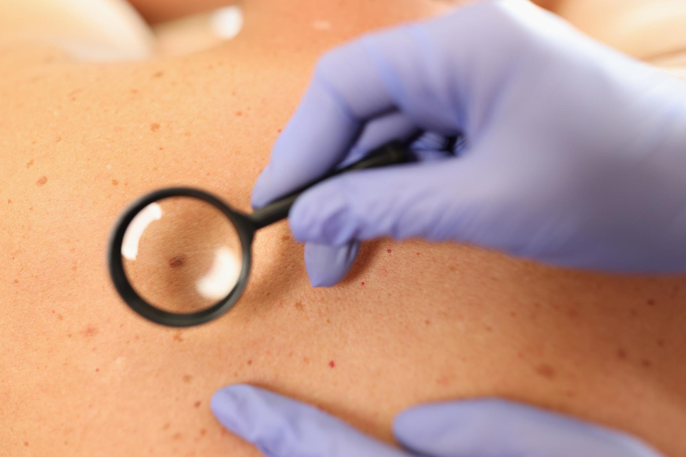Skin Cancer in Australia: Symptoms, Causes & Early Detection | LDS Clinic